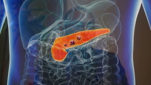 Pancreatic Cancer By Dr Rakesh Rai