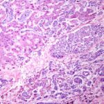 Cholangiocarcinoma Treatment in Dubai