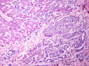 Cholangiocarcinoma Treatment in Dubai