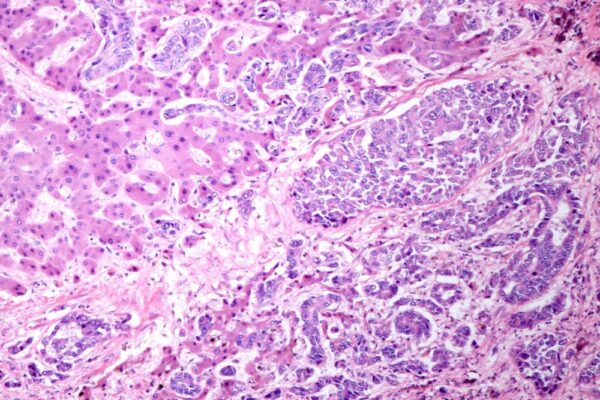 Cholangiocarcinoma Treatment in Dubai
