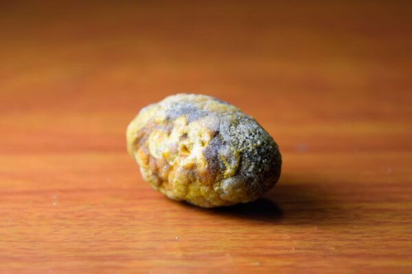 Gallstone Surgery in Dubai