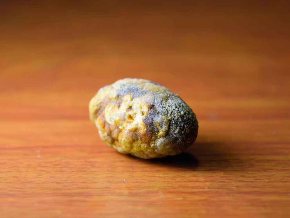 Gallstone Surgery in Dubai