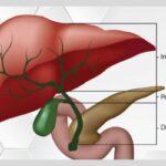 Types of Cholangiocarcinoma