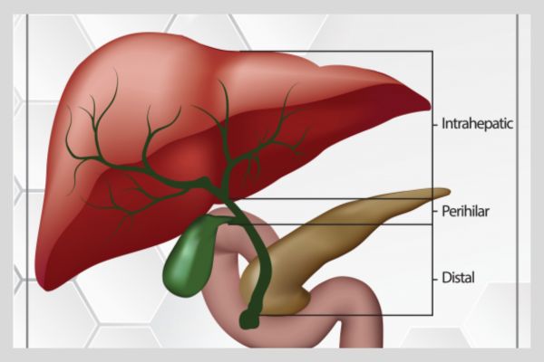 Types of Cholangiocarcinoma